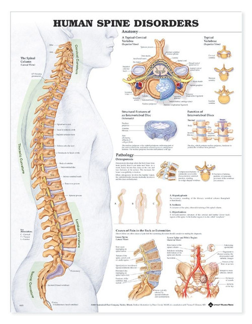 Spine Disorders Anatomical Poster