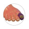 Ulcerated toe