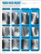 Spinal Decay Insert