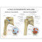 Shoulder Osteoarthritis Anatomical Model Description Card