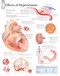 Effects of Hypertension Anatomical Poster