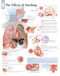 The Effects of Smoking Anatomy Poster