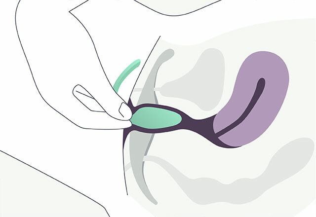 A line drawing of a hand inserting an Elvie trainer into a vagina, with the internal organs shown and coloured in purple