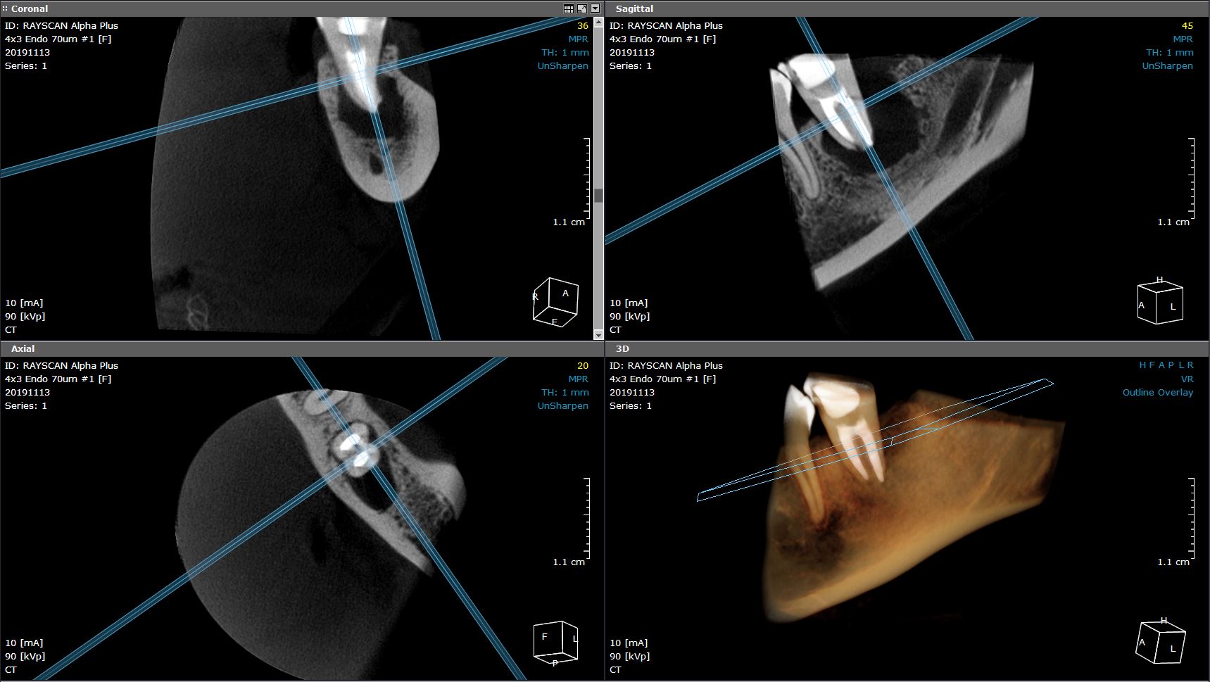 4x3-endo-mode2.jpg