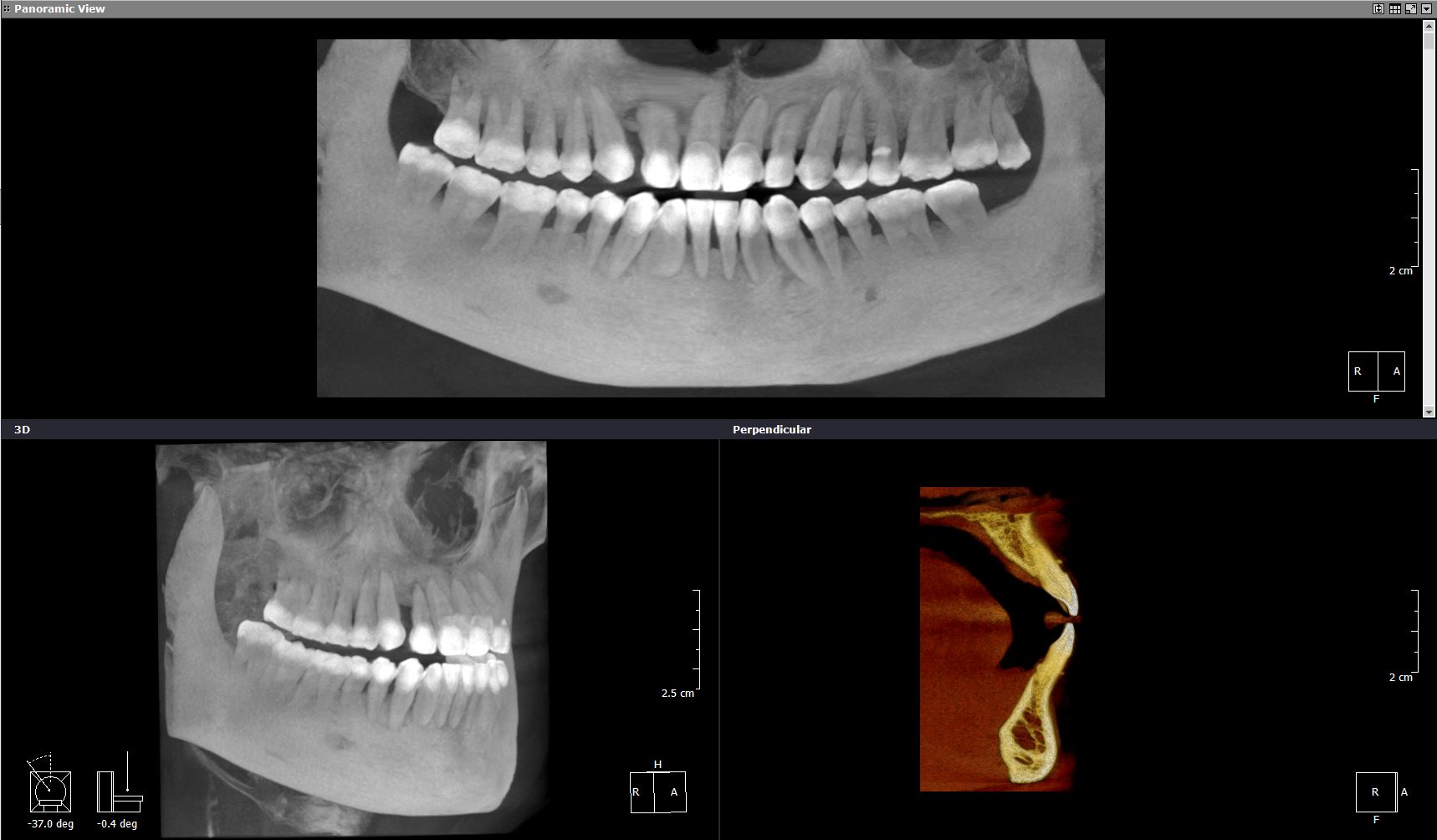 ct-jaw-hd-tl10x10-180um.jpg