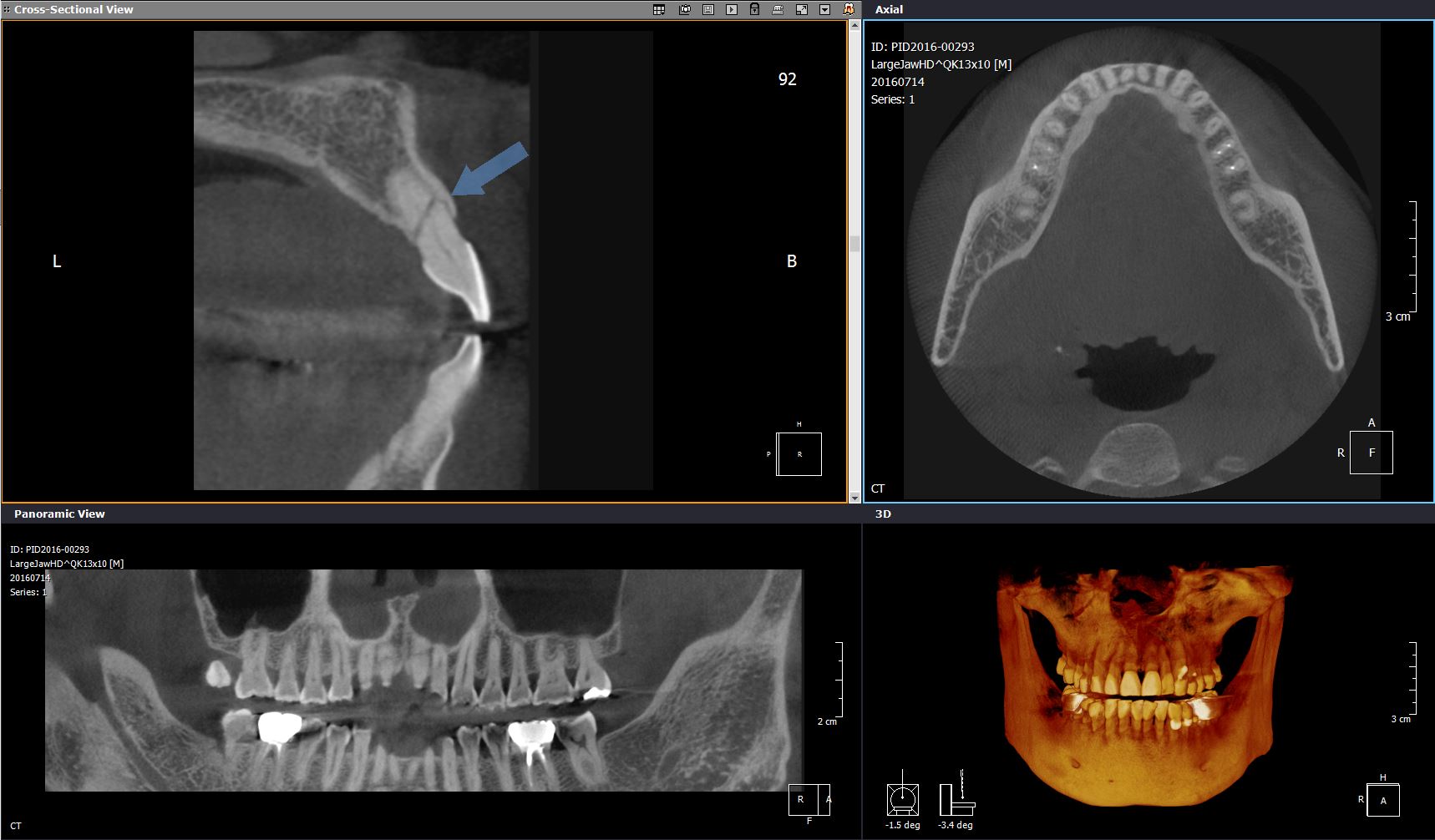 ct-largejaw-hd-qk13x10-180um-11-21-tooth-fracture.jpg