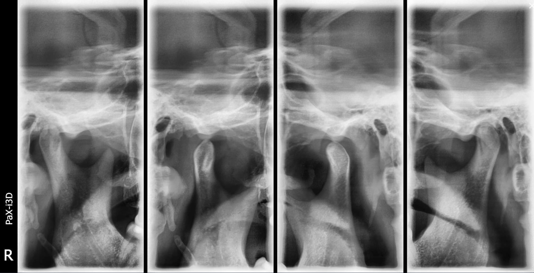 paxi3d-tmj-sample-1.jpg paxi3d-tmj-sample-1.jpg