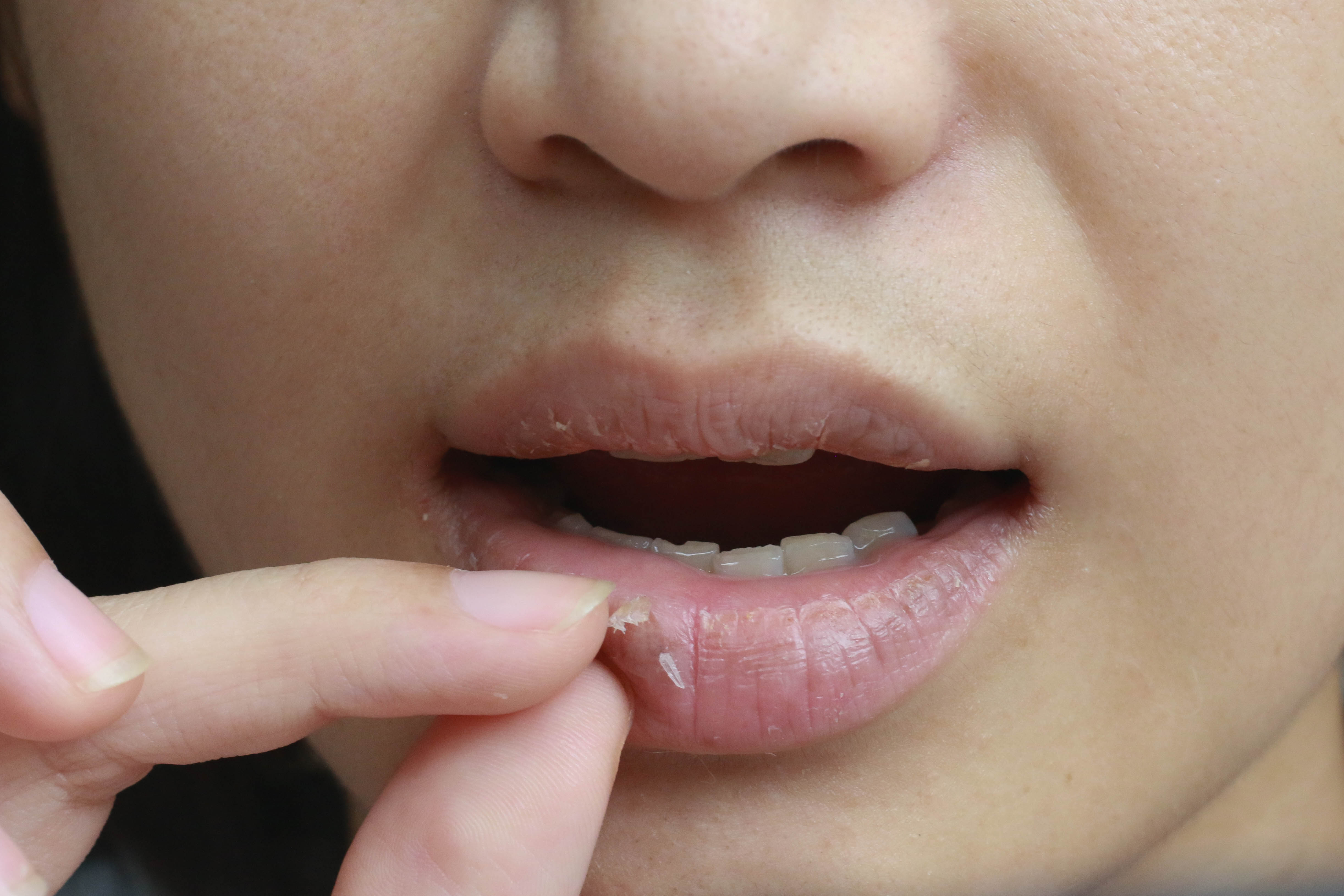 Everything You Need to Know About Chapped Lips 