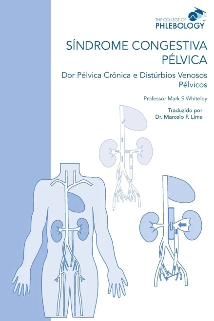SÍNDROME CONGESTIVA PÉLVICA Dor Pélvica Crônica e Distúrbios Venosos Pélvicos (Portuguese Edition)
