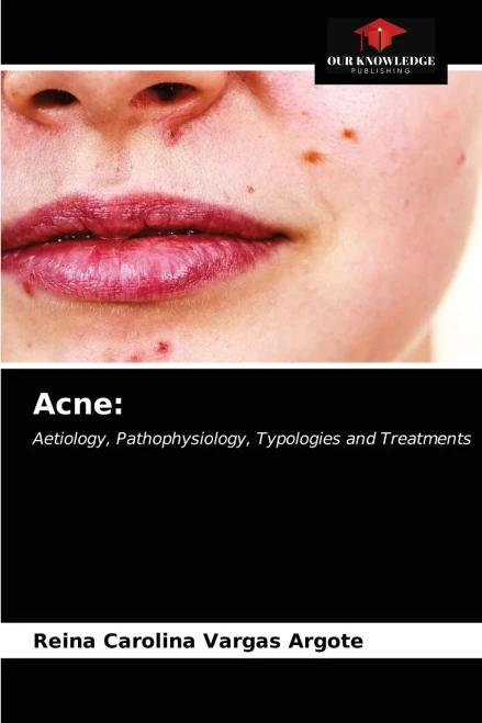Acne:: Aetiology, Pathophysiology, Typologies and Treatments