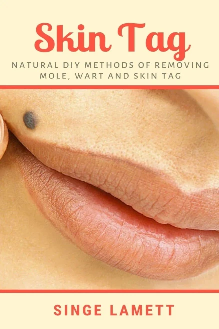 Skin Tag: Natural DIY Methods of removing Mole, Wart and Skin Tag