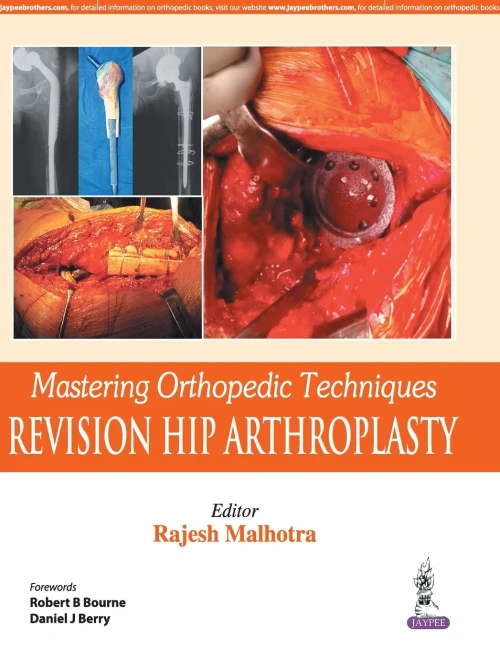 Mastering Orthopedic Techniques: Revision Total Hip Arthroplasty