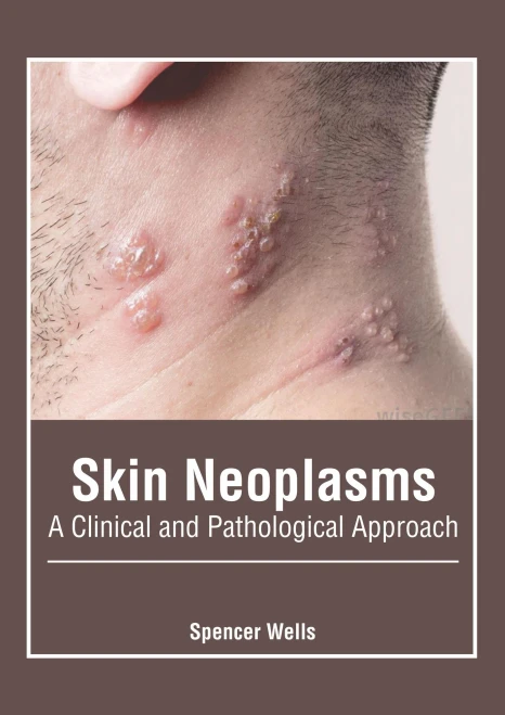 Skin Neoplasms: A Clinical And Pathological Approach