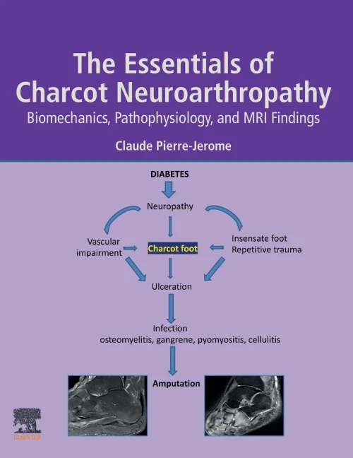 The Essentials Of Charcot Neuroarthropathy: Biomechanics, Pathophysiology, And Mri Findings