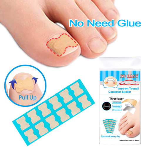 Ingrown Toenail Corrector Stickers Foot Care Stickers Non Glue Toenail Patch Adhesive Toenail Correction Pedicure Toe Nail Treatment Elastic Patch Sticker Blue Stick Bars