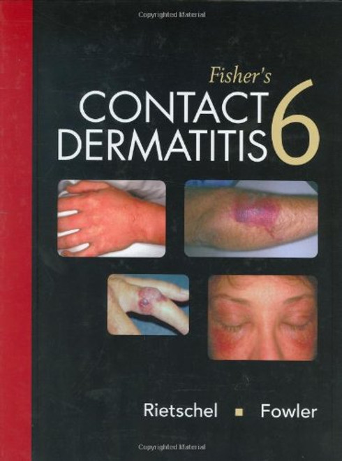 Fisher's Contact Dermatitis, 6e (Rietschel, Fisher's Contact Dermititis) Fisher's Contact Dermatitis, 6e (Rietschel, Fisher's Contact Dermititis)
