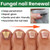 EELHOE 30ml Nail Treatment Essence for Onychomycosis Mild Non-irritating Nail Bright Shiny Repair Nail Repair Solution