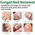 EELHOE 30ml Nail Treatment Essence for Onychomycosis Mild Non-irritating Nail Bright Shiny Repair Nail Repair Solution
