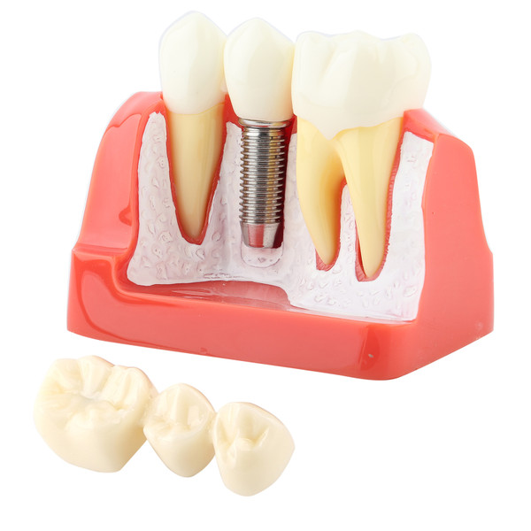 1pc Resin Dental Demonstration Tooth Model Implant Analysis Crown Bridge for Dentist