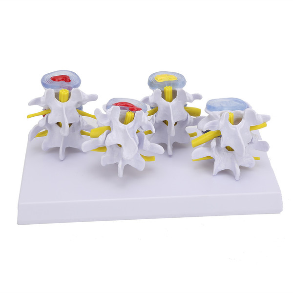 4-stage Medicals Human Lumbar Vertebrae Combination of Normal and Pathological Models