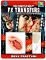 FX Transfers Bone Fracture