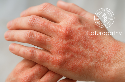 Atopic Dermatitis and Gut Health: Healing the Skin by First Healing the Gut