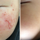 Eczema Before&After