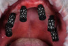 Dot Post with a 3mm Tissue Collar on a maxilla