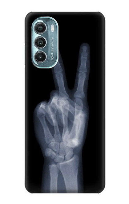 W3101 X-ray Peace Sign Fingers Hard Case and Leather Flip Case For Motorola Moto G Stylus 5G (2022)