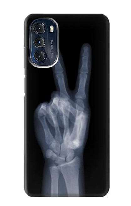 W3101 X-ray Peace Sign Fingers Hard Case and Leather Flip Case For Motorola Moto G 5G (2023)