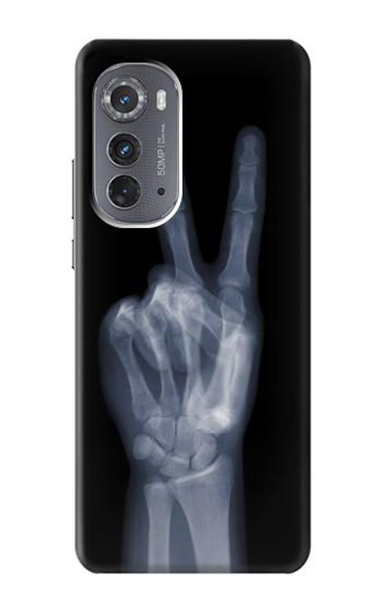 W3101 X-ray Peace Sign Fingers Hard Case and Leather Flip Case For Motorola Edge (2022)