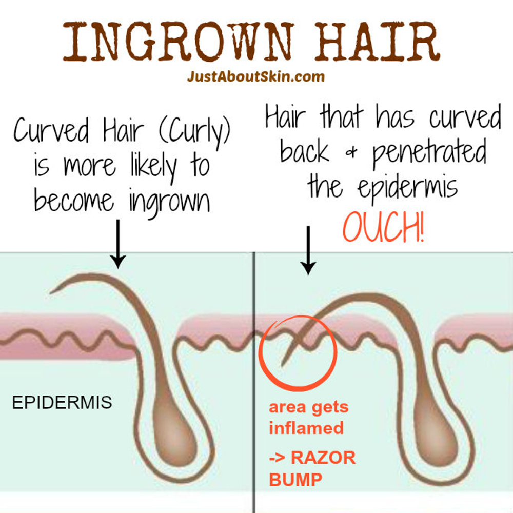 6 Tips for Reducing Razor Bumps & Ingrown Hairs When Shaving