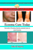 Eczema Cure Today - Get rid of Eczema forever natural ways to cure Eczema