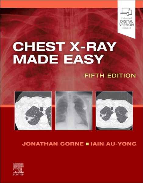 Chest X-Ray Made Easy - 9780702082344