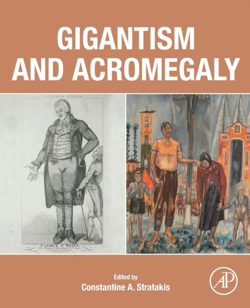 Gigantism And Acromegaly