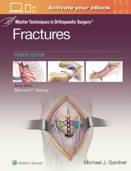 Master Techniques In Orthopaedic Surgery: Fractures