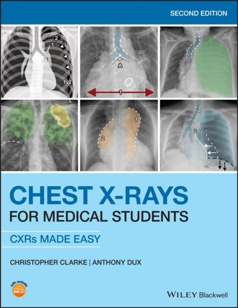 Chest X-rays for Medical Students - CXRs Made Easy  2nd Edition