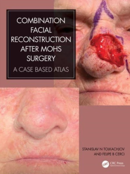 Combination Facial Reconstruction after Mohs Surgery : A Case Based Atlas