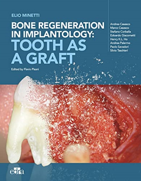 Bone Regeneration In Implantology - Tooth As A Graft