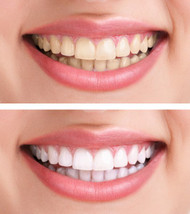 5 At-Home Tooth Whitening Hacks 