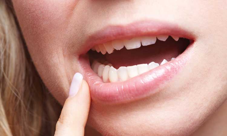 5 Natural Cures for Canker Sores 5 Natural Cures for Canker Sores