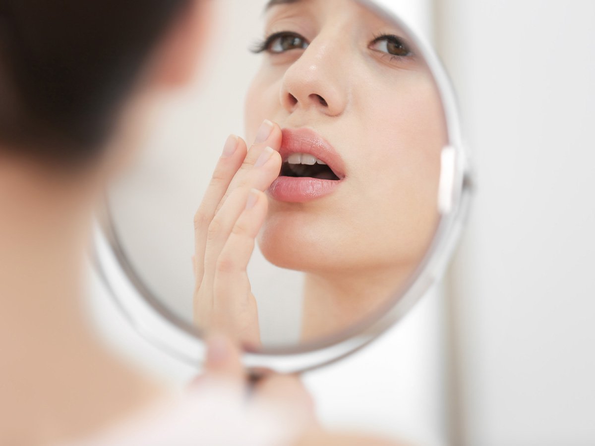 Home Remedies for Cold Sores Home Remedies for Cold Sores