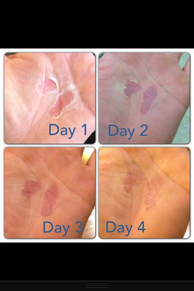 Winnies RipFix Travel Size