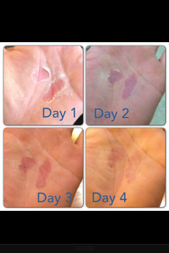 Winnies RipFix Standard Size