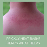 Prickly Heat Rash - Causes, Prevention & Treatment