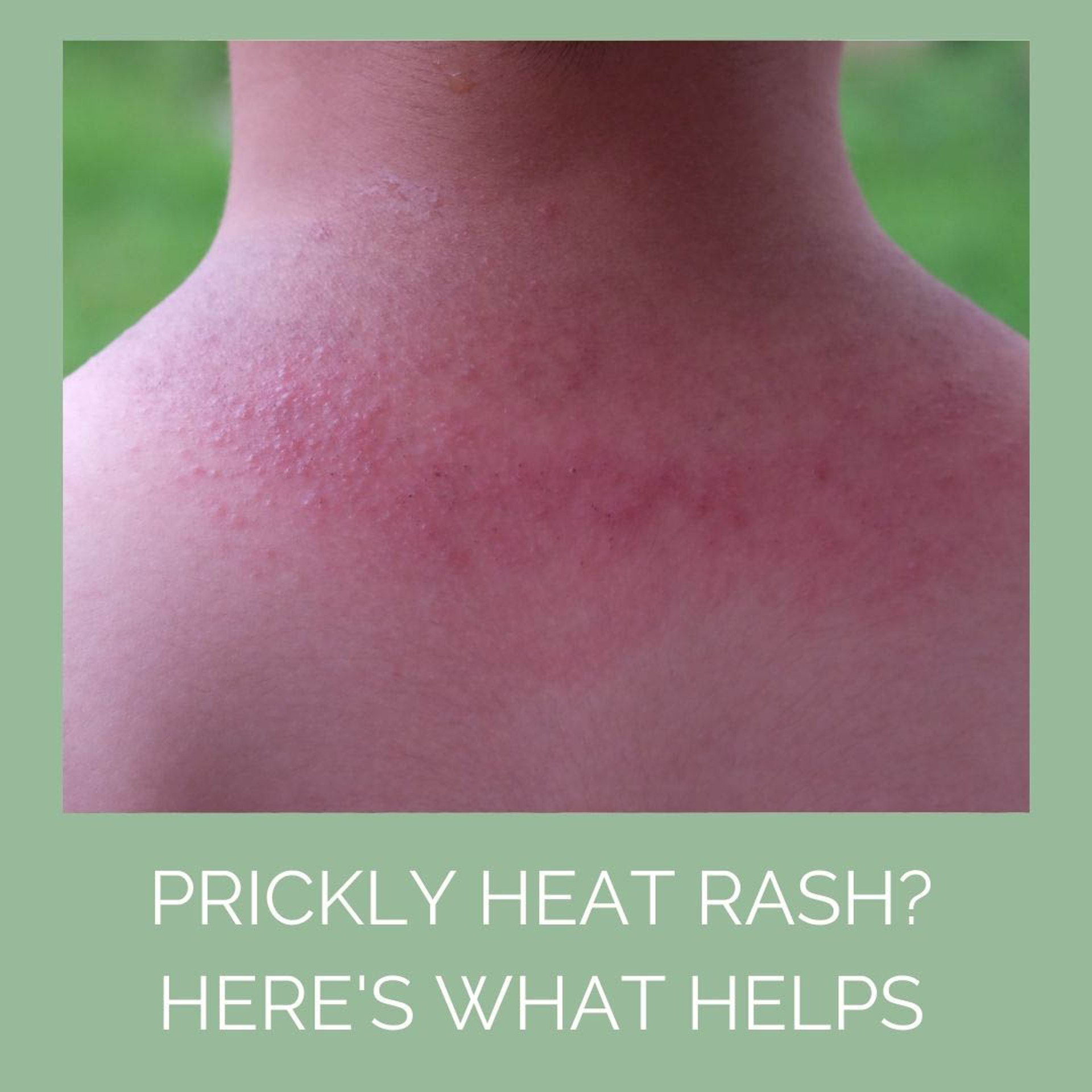 Prickly Heat Rash Causes, Prevention & Treatment Odylique