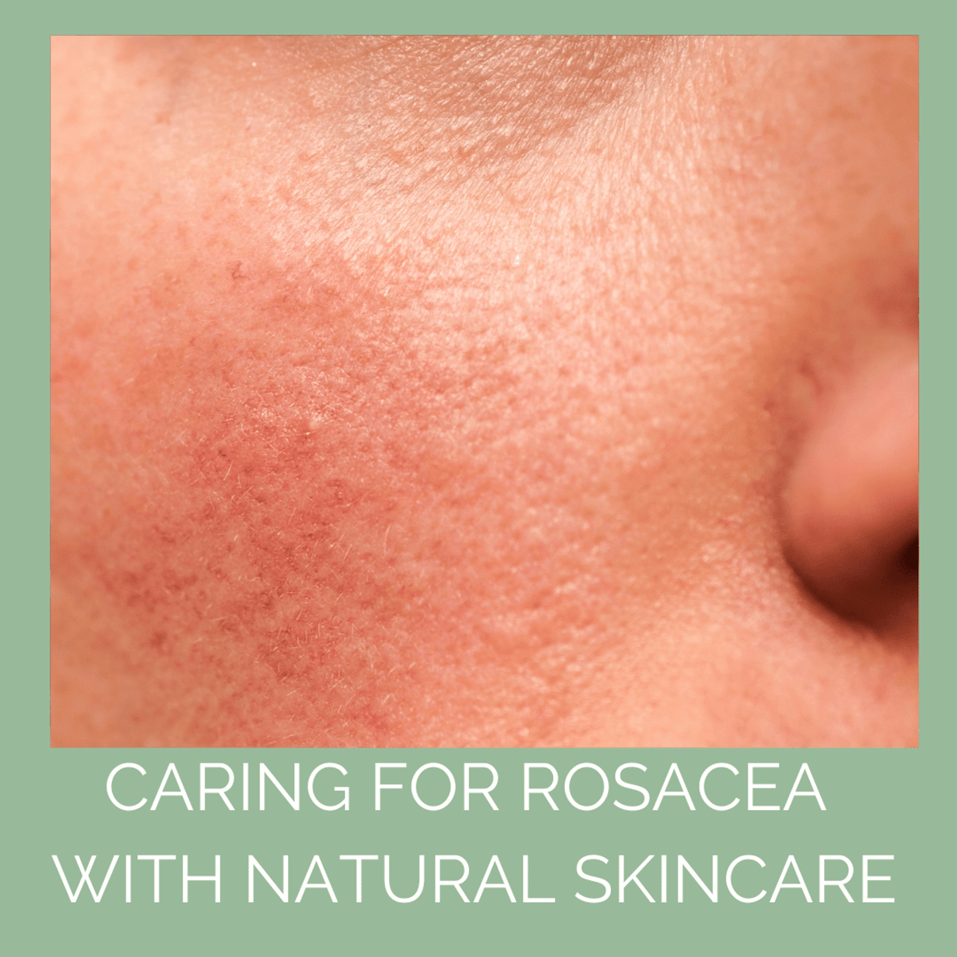 The Ultimate Guide to Rosacea and Natural Skincare - Odylique