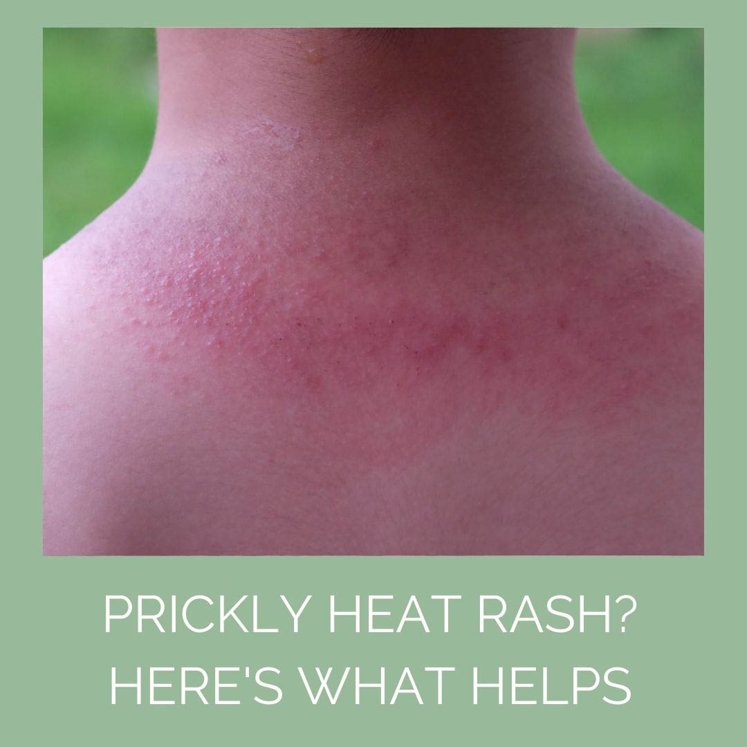 Prickly heat (heat rash)- Causes, home remedies and preventions