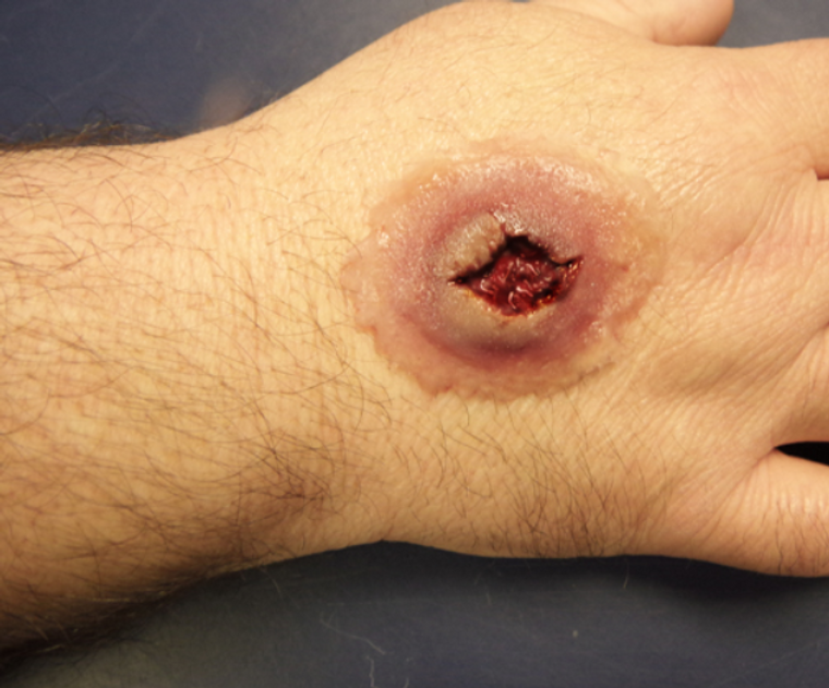 Techline Trauma Large Self Adhesive Gun Shot Wound.