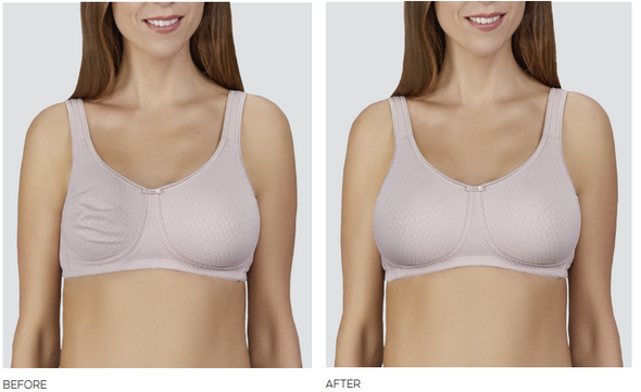 Balance Adapt Air Medium Delta Adjustable Breast Shaper 
Before and After Breast Asymmetrical